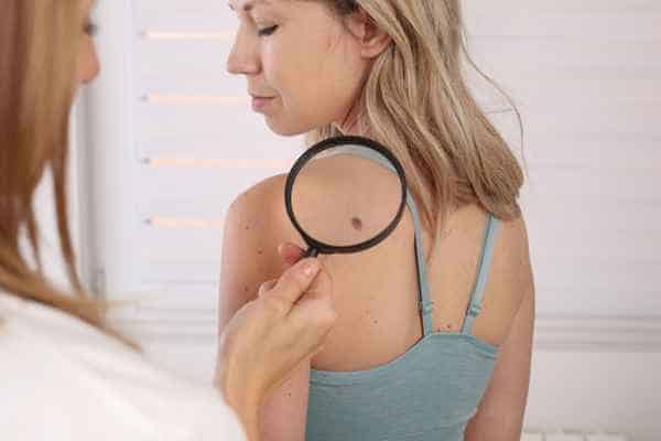 What Are Traditional Skin Lesion Removal Methods Nantwich?