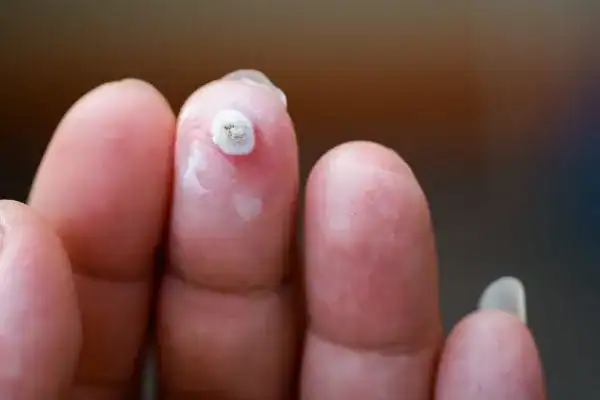 Image of white wart before cryopen treatment Nantwich
