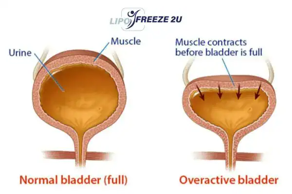 diagram of overactive bladder treatment Nantwich