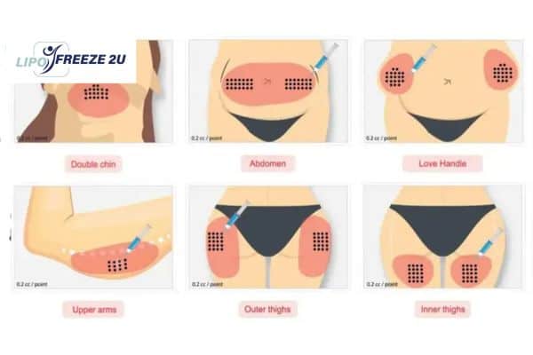 Benefits of Choosing Aqualyx for Fat Reduction Nantwich