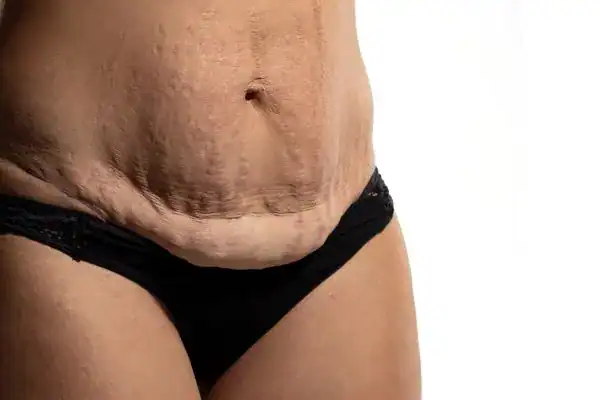 loose skin after weight loss injections Nantwich