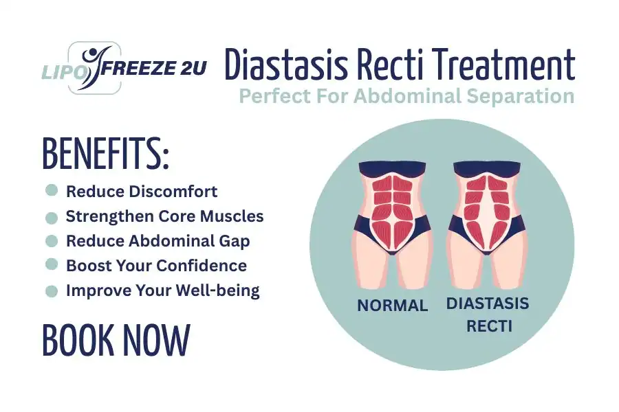 How Long Will It Take to See Improvements in Diastasis Recti Nantwich