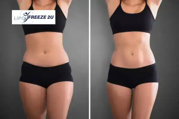 How Can LIPO FREEZE 2U Support Your Post-Pregnancy Body Recovery Nantwich?