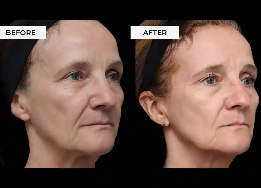 How Many RF Microneedling Sessions Will You Need to See a Difference Nantwich?