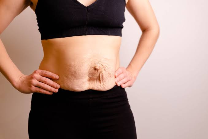 Is Surgery Really the Only Way to Repair Diastasis Recti Nantwich?