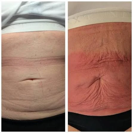 How Does RF Microneedling Improve Crepey, Thin and Uneven Skin Texture Nantwich?