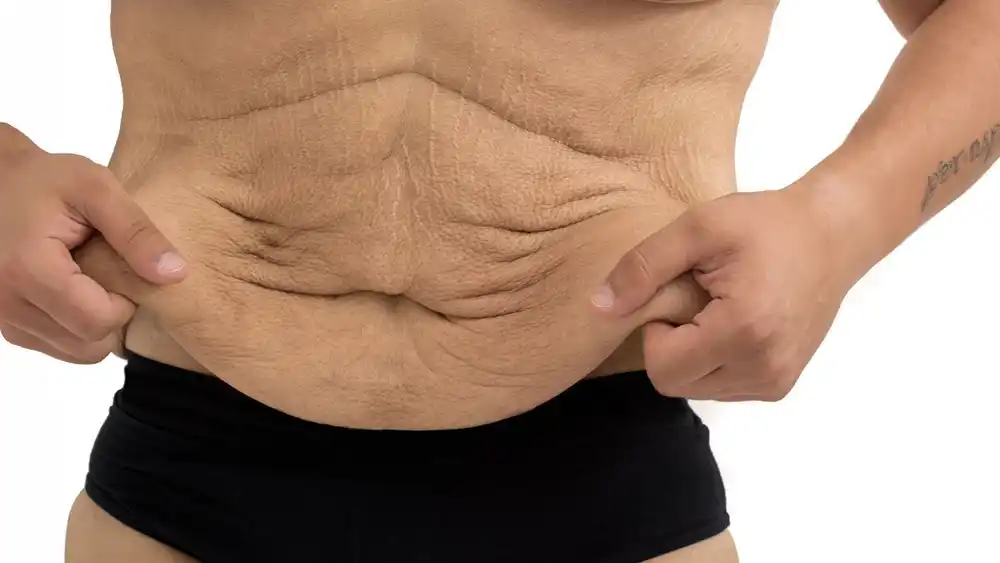 RF Microneedling for Loose Skin: How Can It Help Tighten and Reshape the Skin Nantwich?